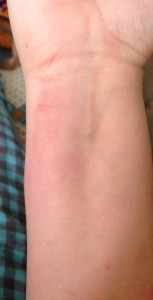 Angioedema near my wrist
