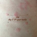 CIU and my 2 1/4 year battle